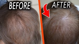 Topical Finasteride  1 month Update Only one side effect [upl. by Irap753]