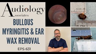 BULLOUS MYRINGITIS amp EARWAX REMOVAL  EP631 [upl. by Aelanna]