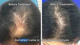 Hair Loss Treatment for Men amp Women TED Hair Ultrasound Demo [upl. by Annaicul]