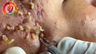 Ultimate Pimple Popping 2024 Satisfying Blackhead Extractions amp Acne Solutions [upl. by Vershen]