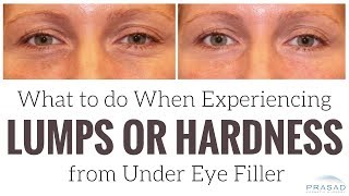 What to do When Experiencing Lumps or Hardness from Under Eye Filler [upl. by Niwrud]