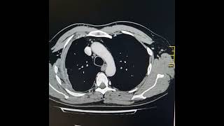 Small hydropneumothorax on right side with pleural cortication [upl. by Gretal66]