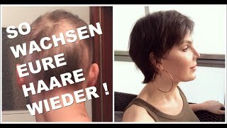 MEDIKAMENTE gegen KREISRUNDEN HAARAUSFALL 💊 MEINE THERAPIE 💉 [upl. by Tonye]