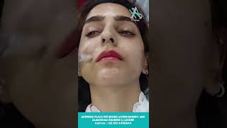 RF Micro needling Transform Your Skin with Advanced Treatmentquot skincare aestheticglow beauty [upl. by Janel237]