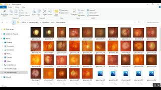 Fuzzy acceptance Analysis of Impact of Glaucoma and Diabetic Retinopathy using Confusion Matrix [upl. by Aubry]