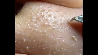 blackheads removal using nipper is so satisfying [upl. by Ainalem]