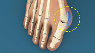 Bunions Why You Get Them and How Theyre Removed [upl. by Blunk]