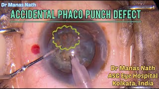 Accidental Phaco Punch Defect during emulsification [upl. by Sundstrom412]