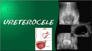 Urografía Excretora II [upl. by Fredette]