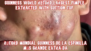 ESPINILLAS Y GRANOS Récord mundial Guinness de la espinilla más grande extraída [upl. by Aillicec661]