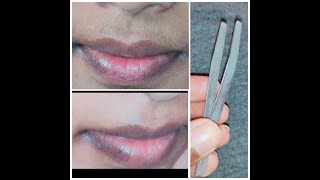 upperlip hair removal Remove unwanted hair on face using PLUCKER facialhairremoval painless method [upl. by Hollinger]