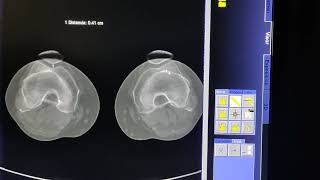 CALCULO DE TUBEROSIDAD TIBIAL EN TOMOGRAFIA [upl. by Ahsinik]