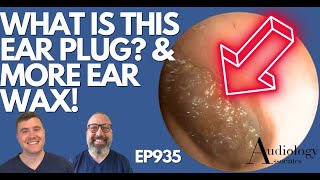 THATS NOT AN EARWAX PLUG amp MORE EAR WAX REMOVALS  EP935 [upl. by Steep634]