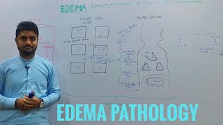 EdemaOedemaEdema pathologyintroduction to edema [upl. by Levona]