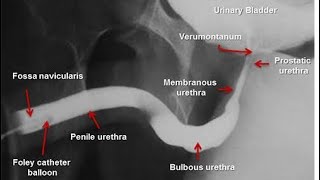 Retrograde Urethrogram  Ascending urethrography [upl. by Soisatsana]