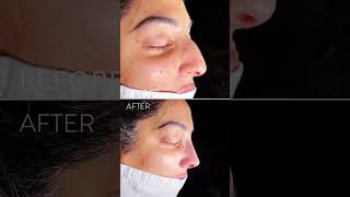 BeforeAfter Rhinoplasty by Dr Jamil  Face Cosmetic Surgery Toronto [upl. by Asoj147]