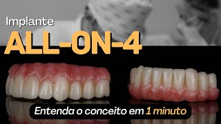 Implantes Allon4  Entenda o Conceito em 1 minuto [upl. by Ramar]