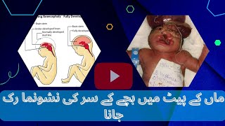 Encephaly kya hota haianencephaly in hindianencephaly baby 👶 [upl. by Ryle343]