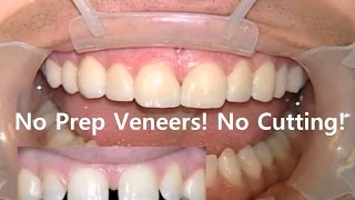 No Prep Dental Veneers Non Prepped Laminates in Korea No Cutting [upl. by Evangelist567]