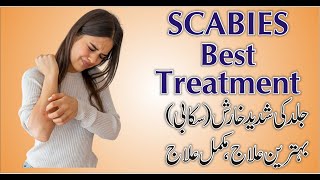 Scabies  Itching  Best Treatment in Homeopathy UrduHindi by Dr Safdar Iqbal [upl. by Vorfeld]