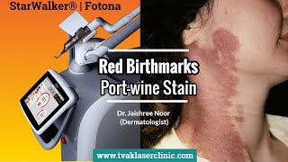 Red Birthmark  PortWine Stain Removal in Delhi  Dr Jaishree Noor  Tvak Laser Clinic [upl. by Seiter]