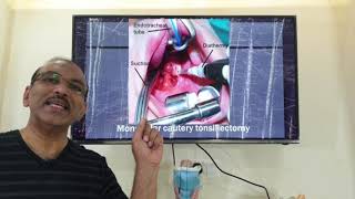 Techniques of tonsillectomy  HINDI Patient teaching programme [upl. by Gaston307]