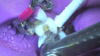 Tips on Avoiding Abrading Adjacent Teeth in a Class II Restoration Palodent® Plus  Dentsply Sirona [upl. by Lauro]