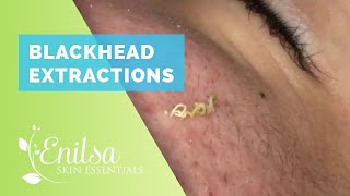 Blackhead Extractions on “K” 9 [upl. by Elletsirhc]