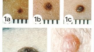 NonMelanoma Skin Cancers  Skin Cancer [upl. by Zehe226]