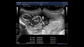 Ultrasound Video showing a Missed abortion or Missed miscarriage with fetal demise [upl. by Assilanna]