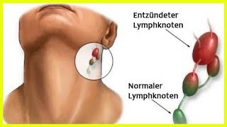 Entzündung der Lymphknoten [upl. by Atthia463]