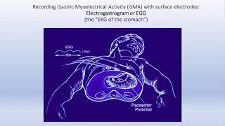 Gastroparesis Review and Update by Kenneth Koch MD [upl. by Scrivenor]