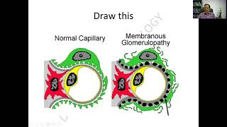 Nephrotic Syndrome Part  2 Membranous Glomerulonephritis MPGN FSGS  RATS in pathology [upl. by Orr]