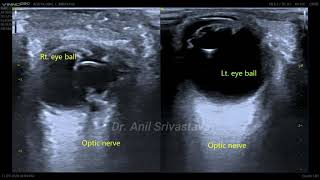 Microphthalmia with persistent primary vitreous [upl. by Lennahs]