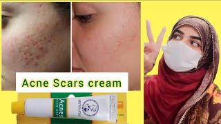 Review Of Acnes Scar Care Gel  How To Use  Medicated Acne Scar Treatment [upl. by Hayalat408]