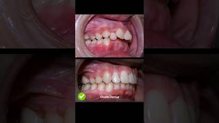 Braces overbite treatment braces orthodontist dentist dental [upl. by Iand]