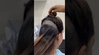 Female hair transplant  Dadu Medical Centre  Dr Nandni Daddu [upl. by Assirroc761]