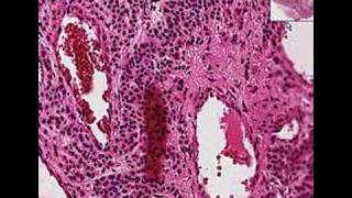 Histopathology SkinGlomus tumor [upl. by Olds568]