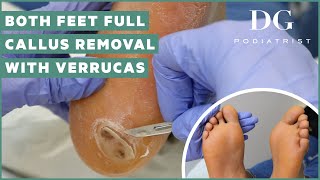 Callus removal from feet both feet and three verruca plantar warts treatment [upl. by Josephina]