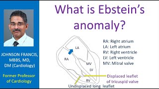 What is Ebstein’s anomaly [upl. by Zacarias]