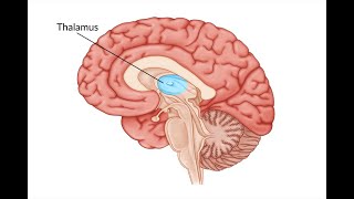 Thalamic Stroke [upl. by Munson644]