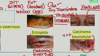 Blefaritis conjuntivitis [upl. by Osrock]