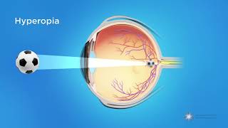 What is Hyperopia Farsightedness [upl. by Hagerman133]