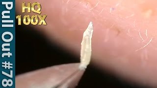 78 Pull Out Blackheads Close up 100X  Blackheads Removal  ピンセットで角栓を抜くHQ100倍 [upl. by Margaretta]