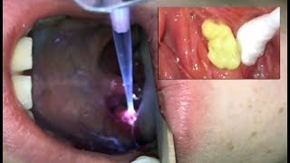 Tonsil Stone Removal  REDUX Tonsil Stone Removal Tools [upl. by Elaynad]