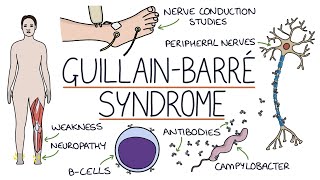 Understanding GuillainBarré Syndrome [upl. by Arem]