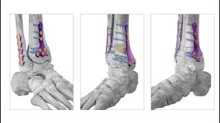 Paragon28 Foot amp Ankle  ANTERIOR DOME  Gorilla Supramalleolar Osteotomy Plating System [upl. by Nilsoj974]