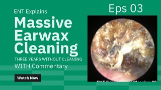 Satisfying Earwax Cleaning 3 Cholesteatoma with Commentary [upl. by Risan460]