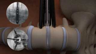 TIMBERLINE® Lateral Fusion System  Surgical Animation [upl. by Seroled]