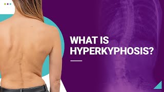 What is Hyperkyphosis [upl. by Lynus]